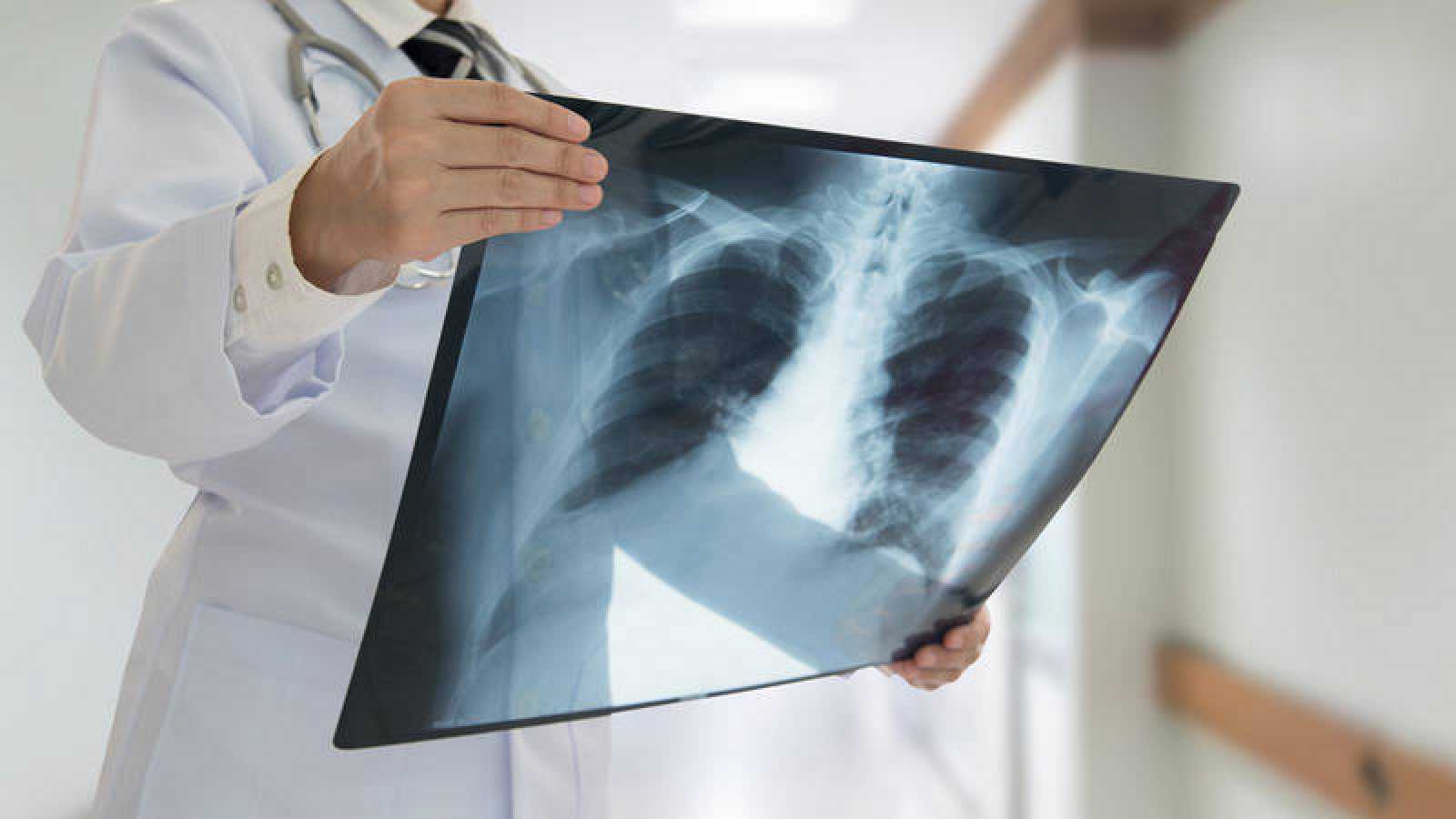 Un manifiesto firmado por casi 500 oncólogos pide prioridad nacional contra el cáncer de pulmón por su mortalidad